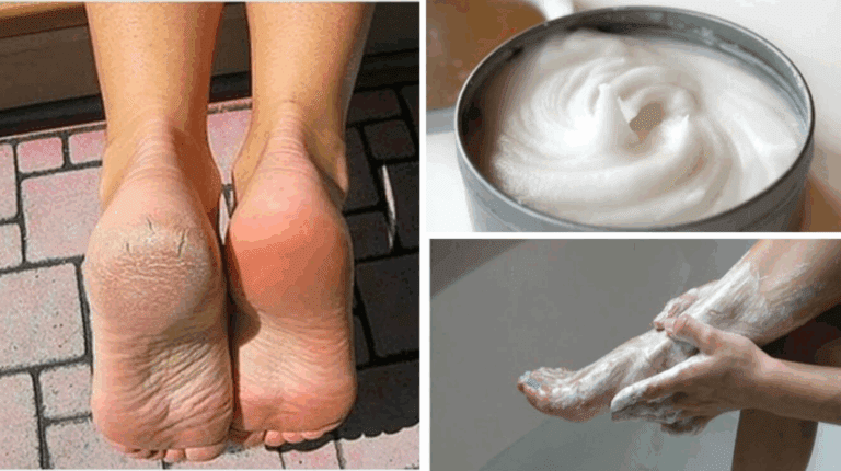 Elimina i funghi dei piedi in modo naturale con questa ricetta fatta in casa.